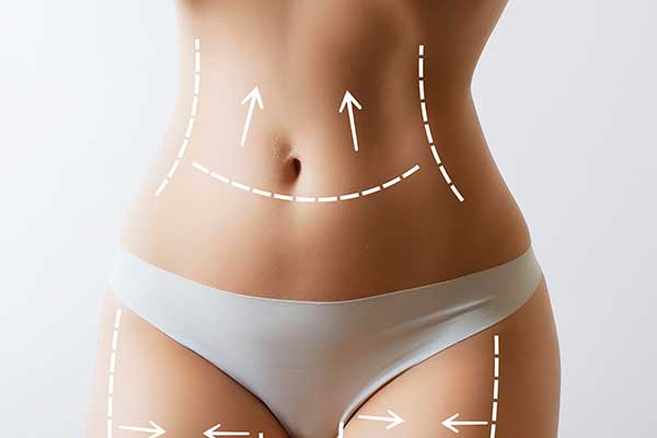 Abdominoplastie