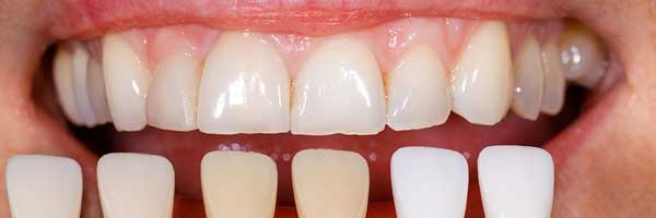 Pose de facettes dentaires Tunisie