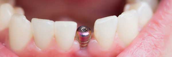 Pose d’implant dentaire Tunisie